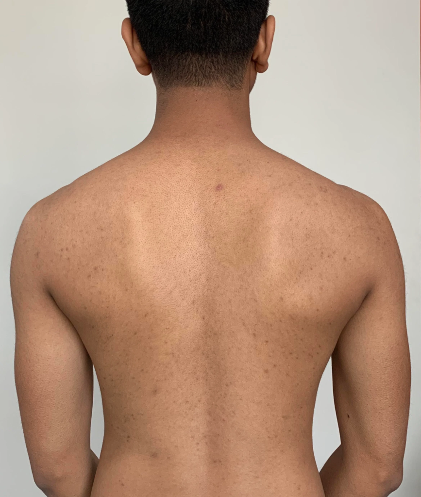 Laser For Hyperpigmentation On Back