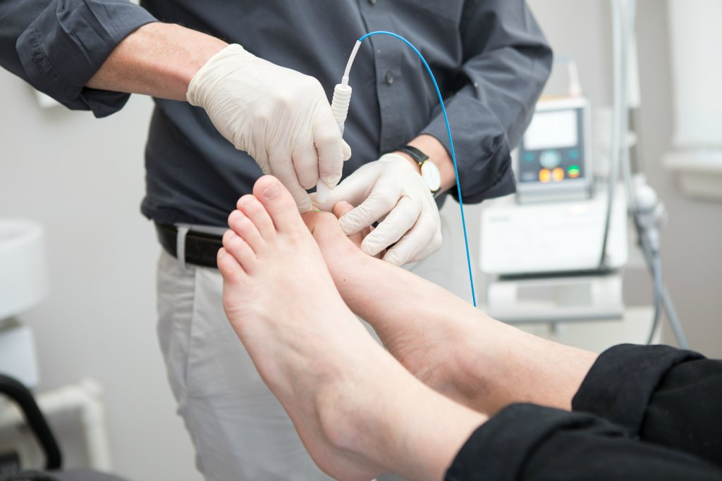 Laser For Fungal Nail Infection