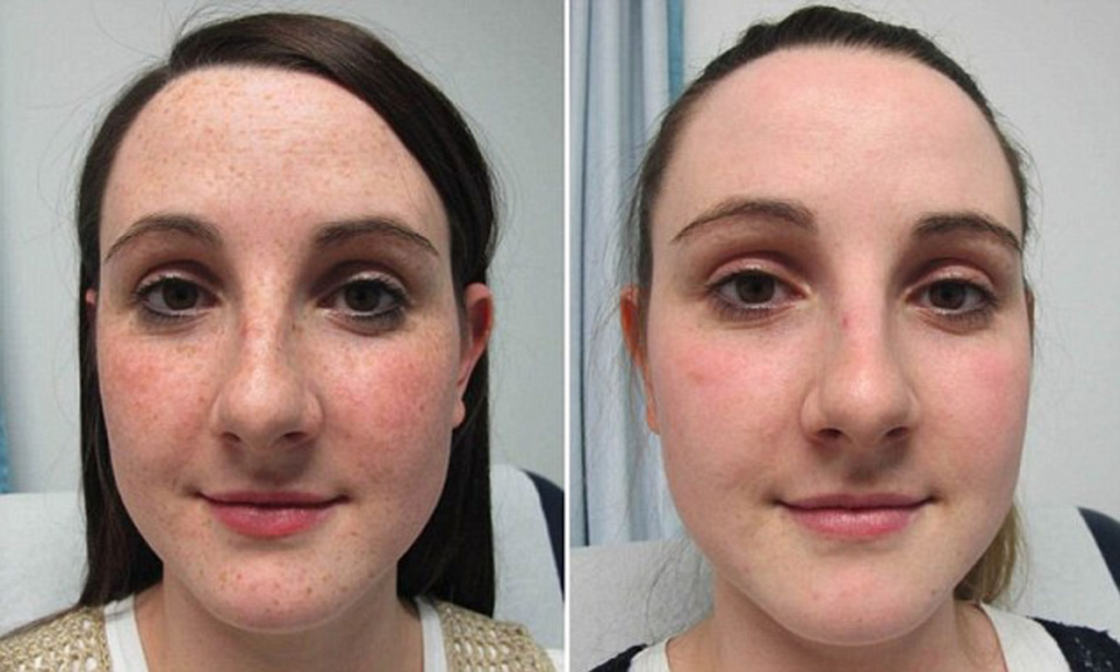 Laser For Freckles Before And After