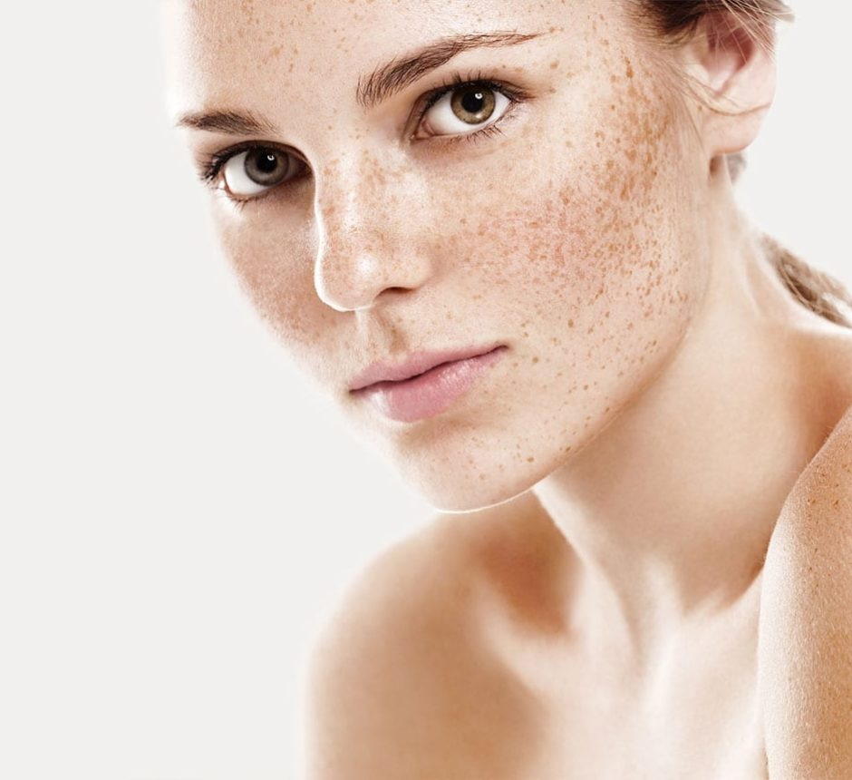 Laser For Freckles And Age Spots