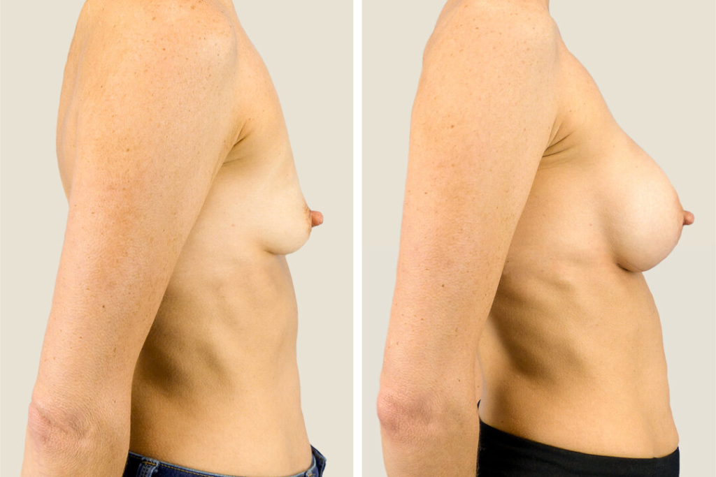 Read more on: Best Natural Breast Augmentation Surgeon