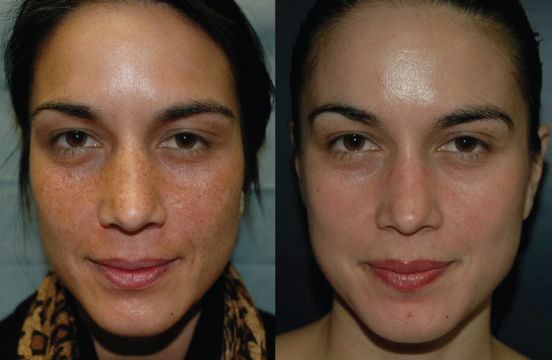 How Long Does It Take To Heal From A Chemical Peel