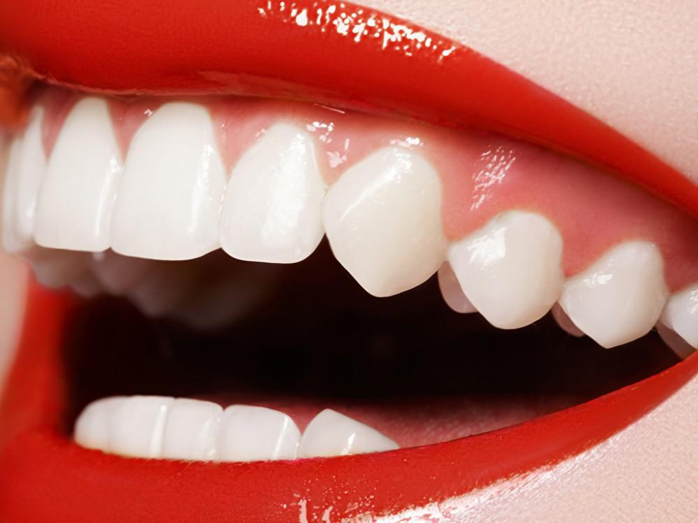 How Much Is It For Teeth Whitening