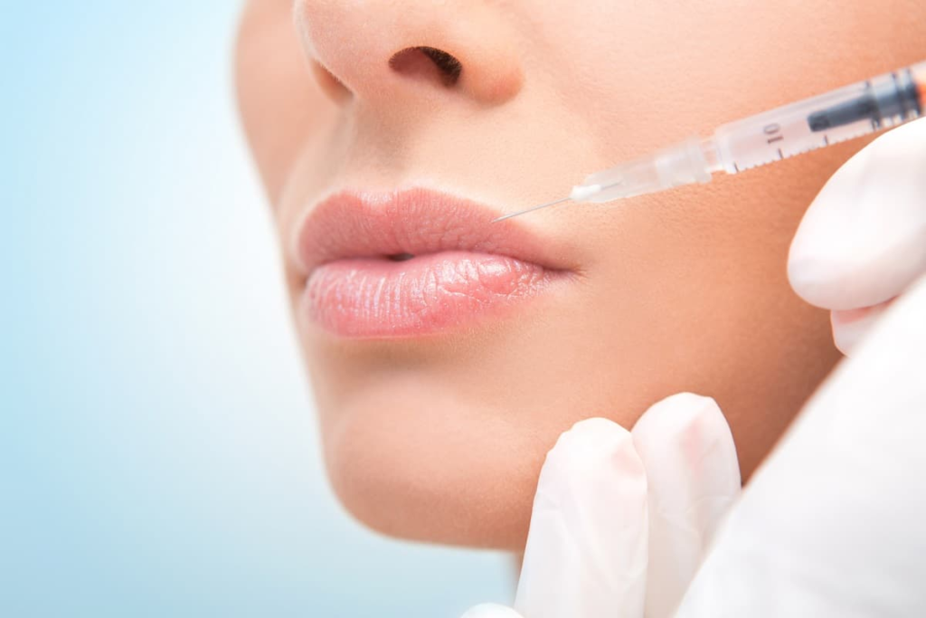 What To Expect After Lip Filler Injections