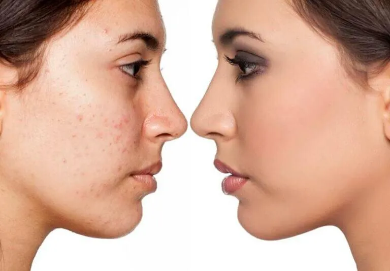 Is Chemical Peel Same As Microdermabrasion