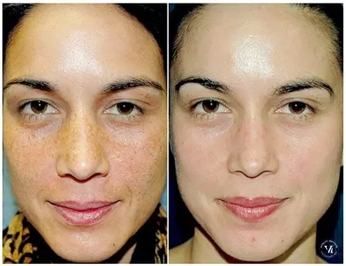 What To Know About Chemical Peel Pigmentation