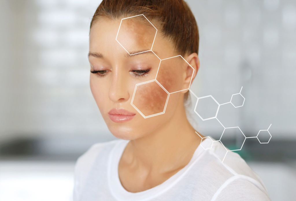 What To Know About Chemical Peel Pigmentation