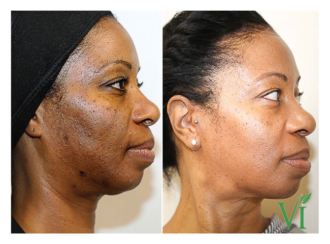 What To Know About Chemical Peel Hyperpigmentation