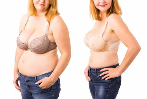 How Will Insurance Cover Breast Reduction