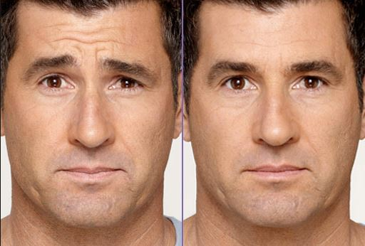 Botox For Men Before And After