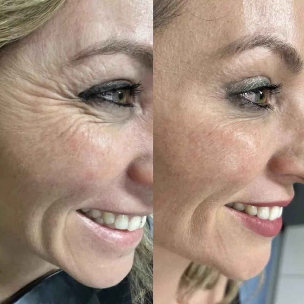 Botox For Forehead Lines