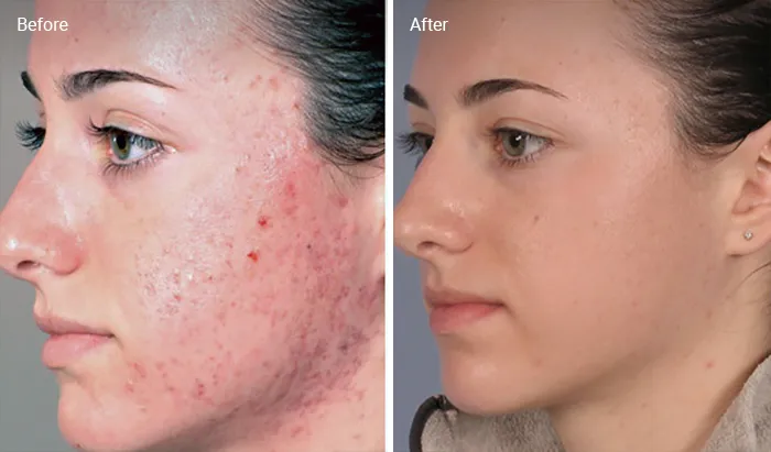 Is Dermabrasion Effective For Acne Scars