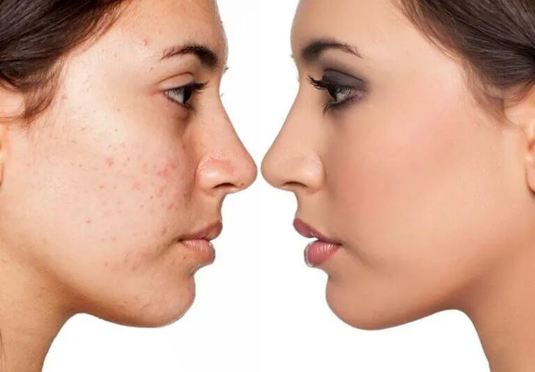 Is Dermabrasion Good For Acne