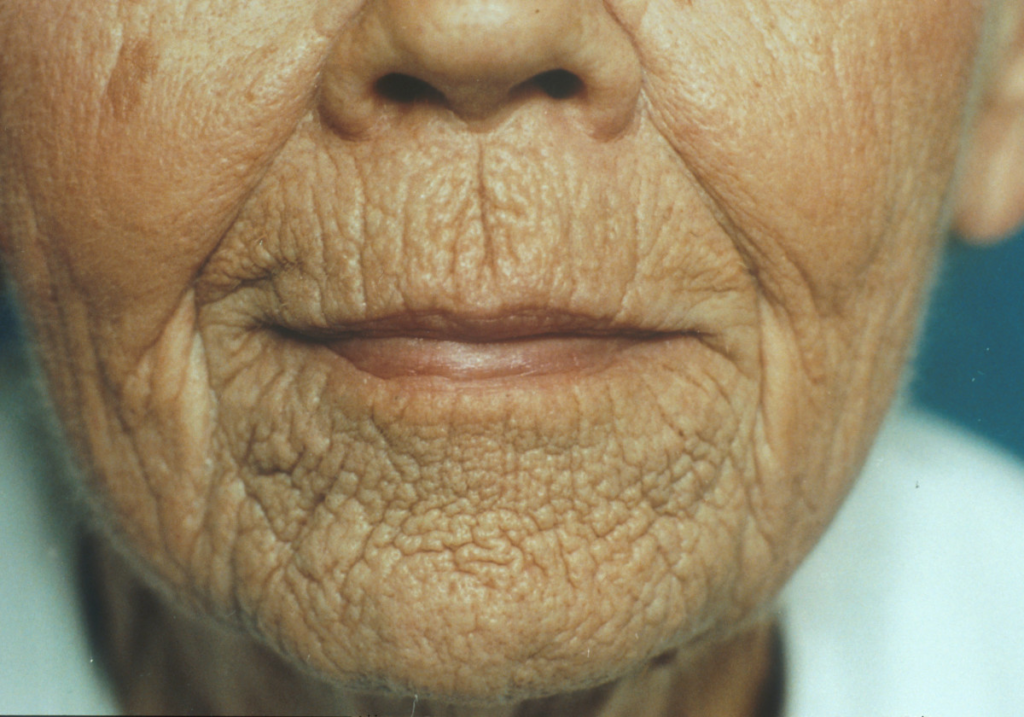 Is Dermabrasion Good For Wrinkles