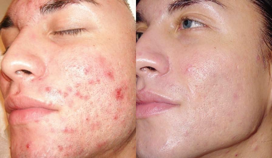 Is Dermabrasion Good For Acne Scars
