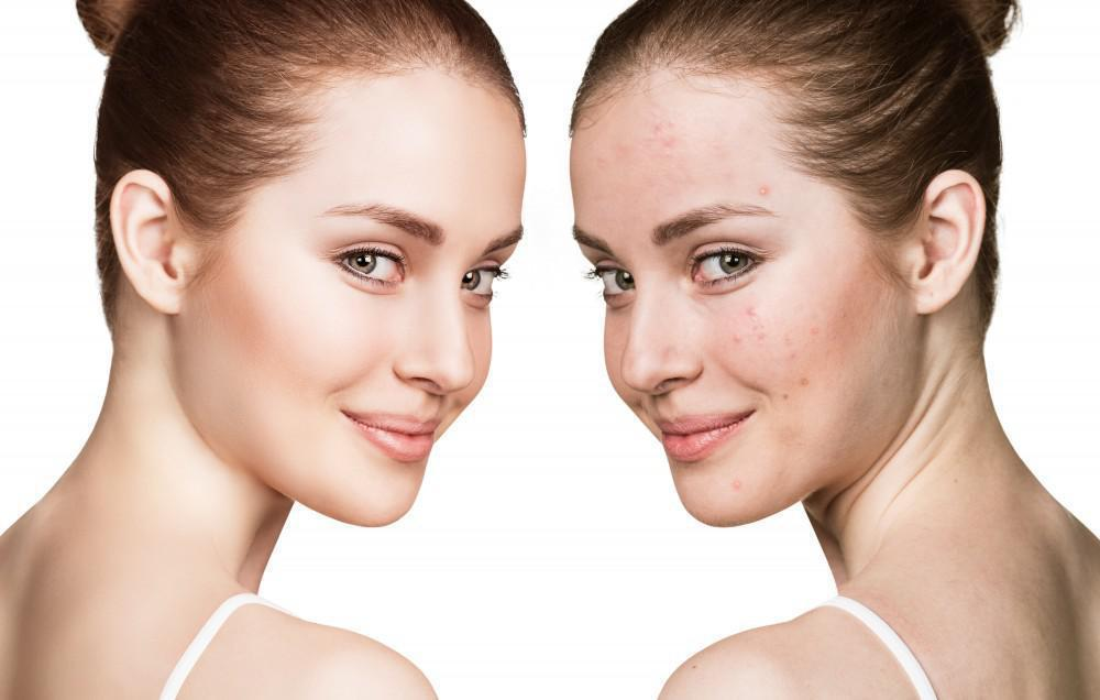 What To Know About Chemical Peel Hindi