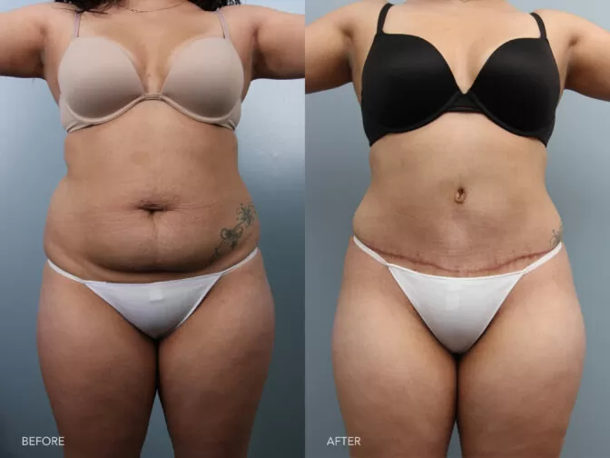 How Long After Gastric Sleeve Can I Get A Tummy Tuck