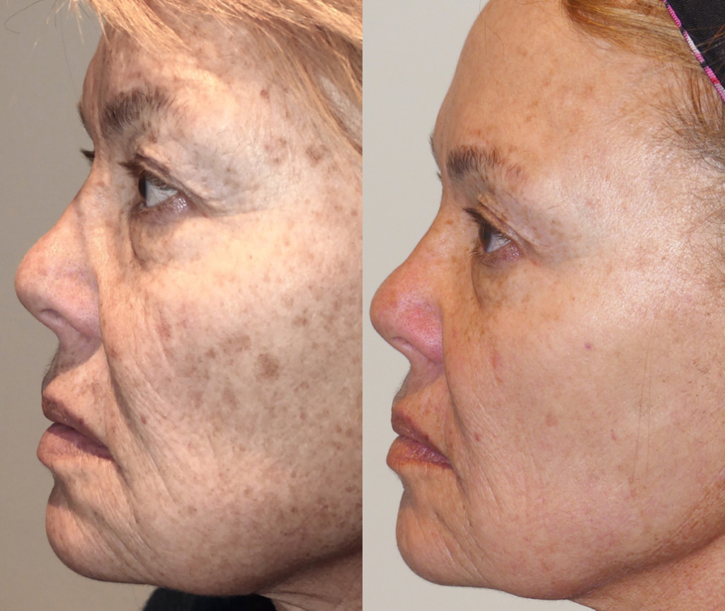 Ipl Laser For Face Wrinkles