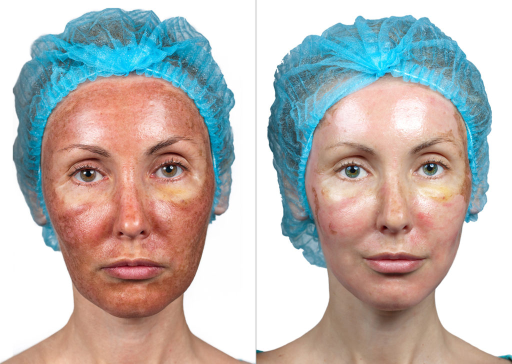 How Much Chemical Peel Process Pictures