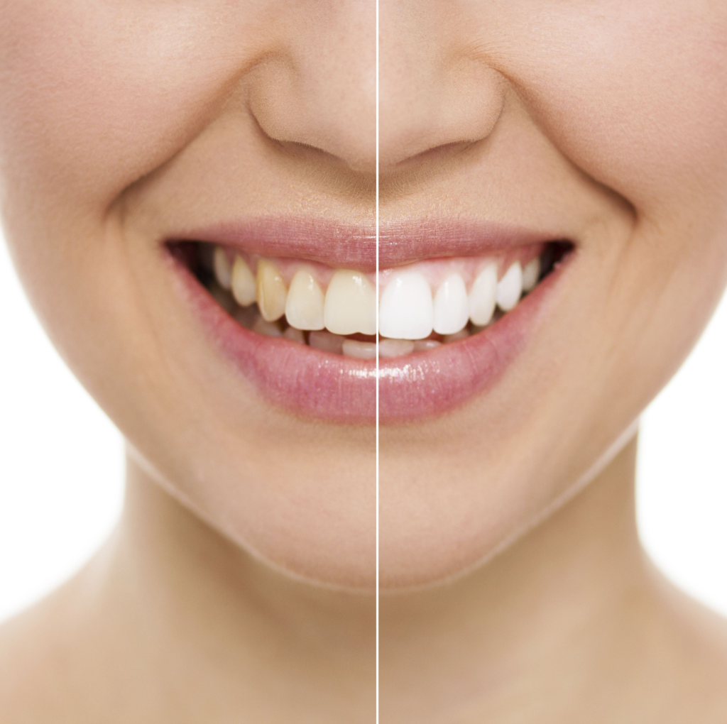 How Long Teeth Whitening Last
