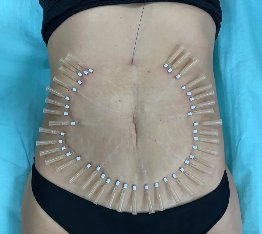 Tummy Tuck With Threads