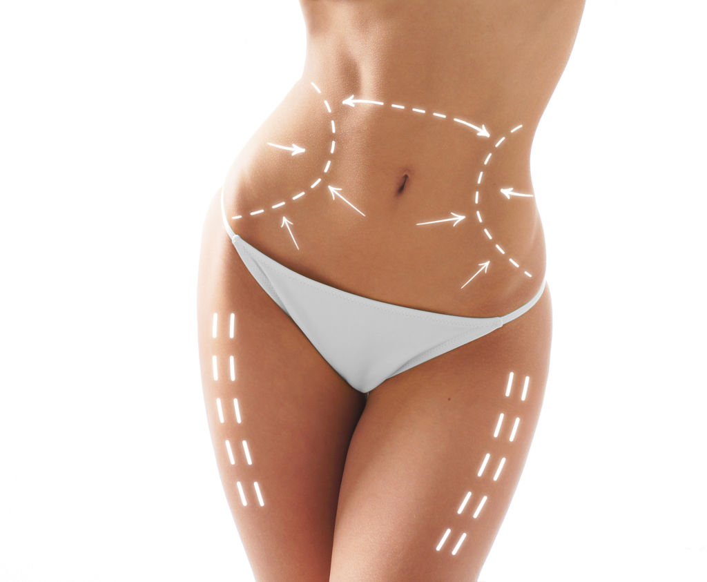Tummy Tuck With Pubic Lift