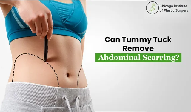 Tummy Tuck with Scar Tissue: Achieving a Flawless Abdominal Contour
