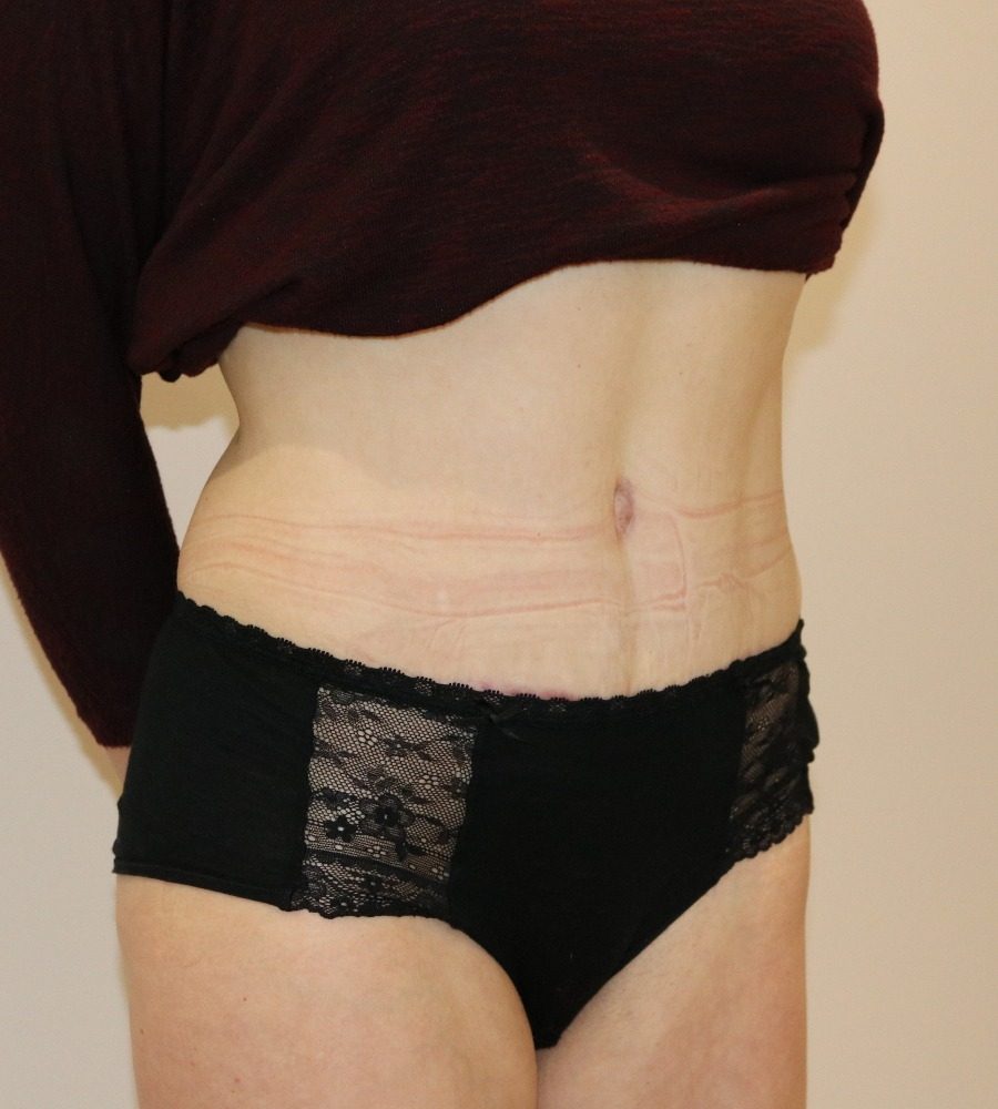 Tummy Tuck With Ostomy