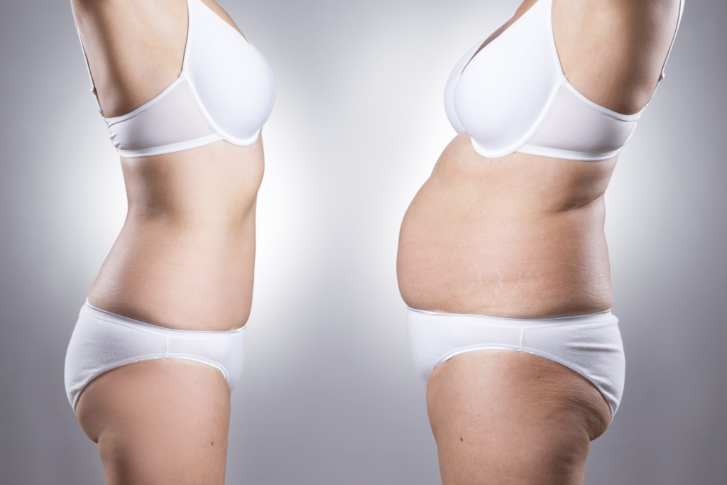 Tummy Tuck With Or Without Liposuction