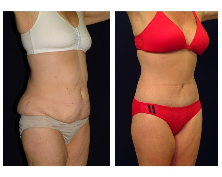 Tummy Tuck With Or Withouth Drains