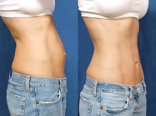 Tummy Tuck With Minimal Scarring