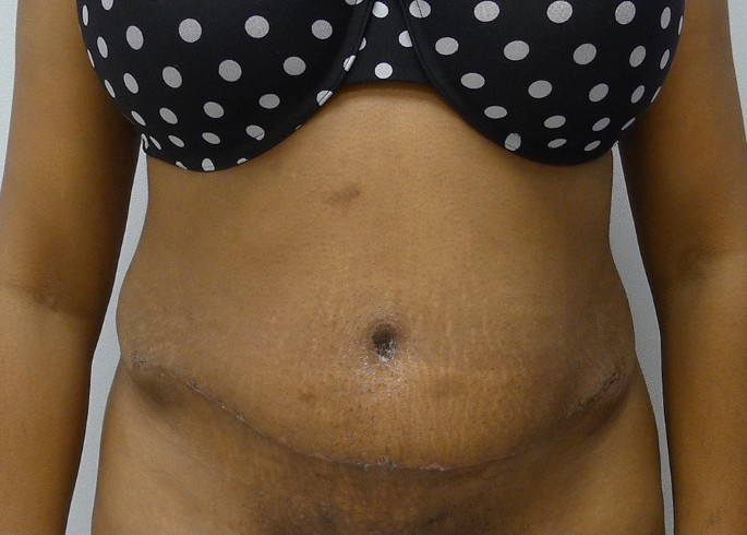 Tummy Tuck With Mesh Reinforcement