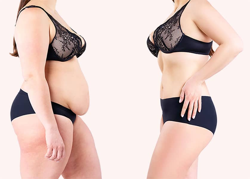 Tummy Tuck With Medicaid