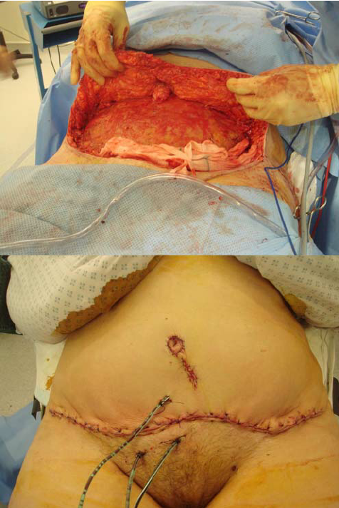 Tummy Tuck Open Wound Healing