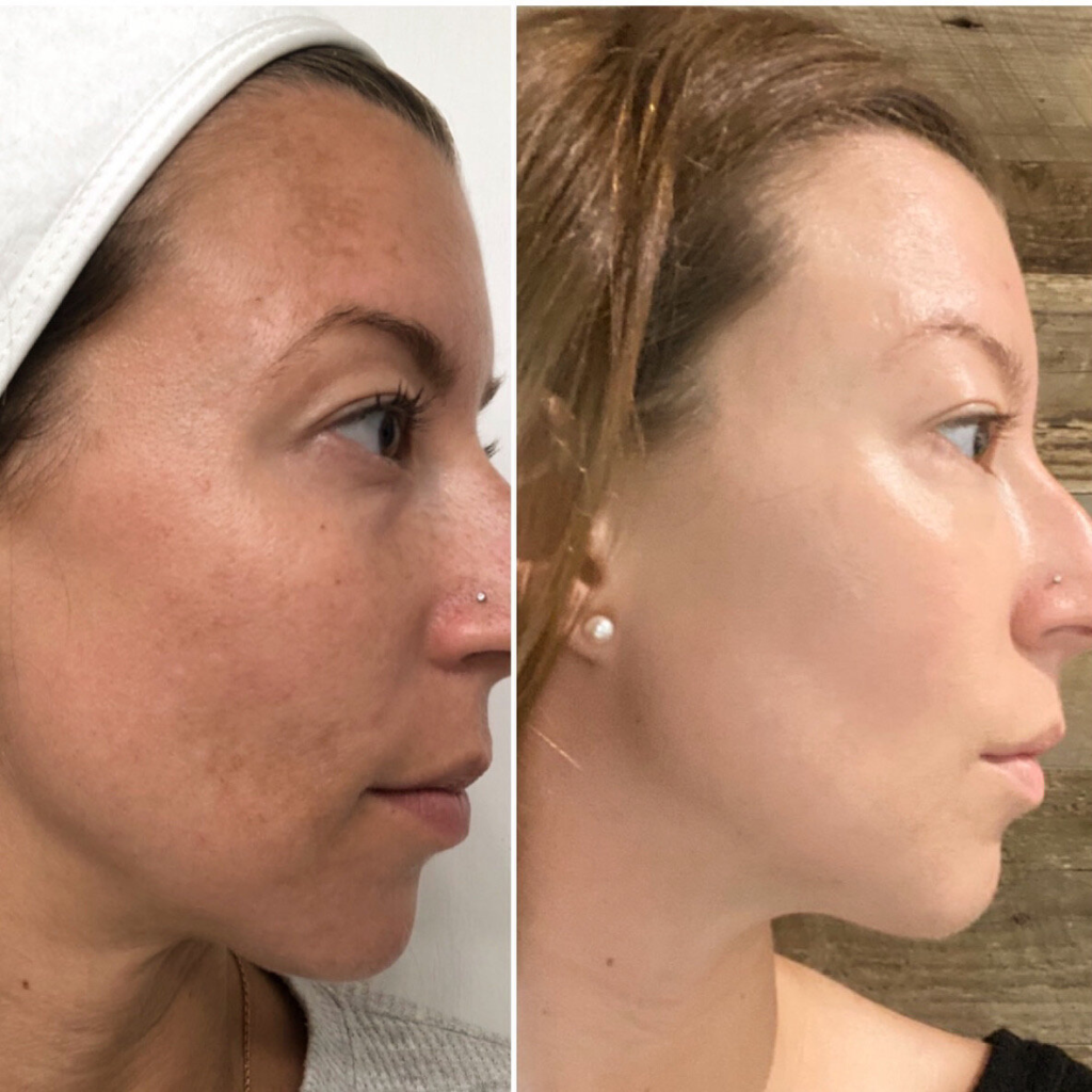 How Long After A Chemical Peel Can I Get Microneedling