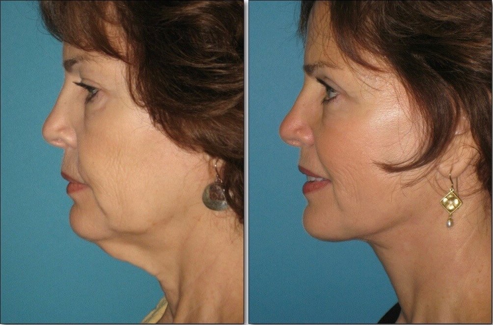 Facelift and Necklift: Achieve Youthful Rejuvenation