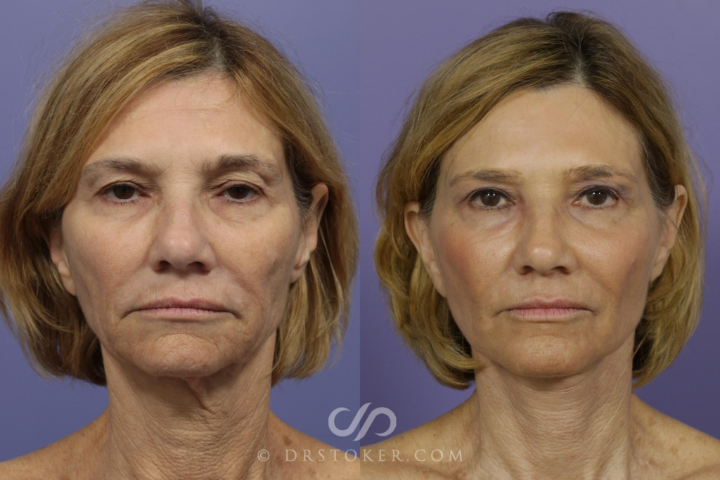 Facelift Surgery in Los Angeles: Transforming Your Appearance with Expert Precision