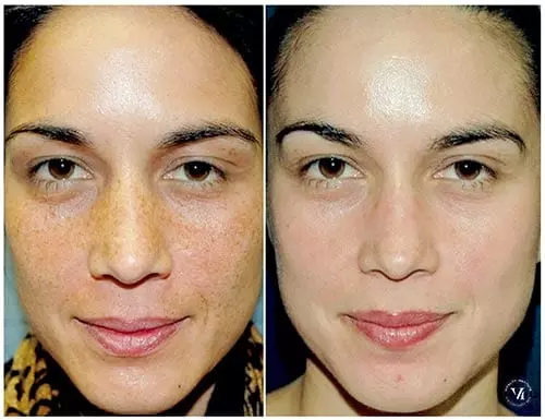 How Frequently Should You Get A Chemical Peel