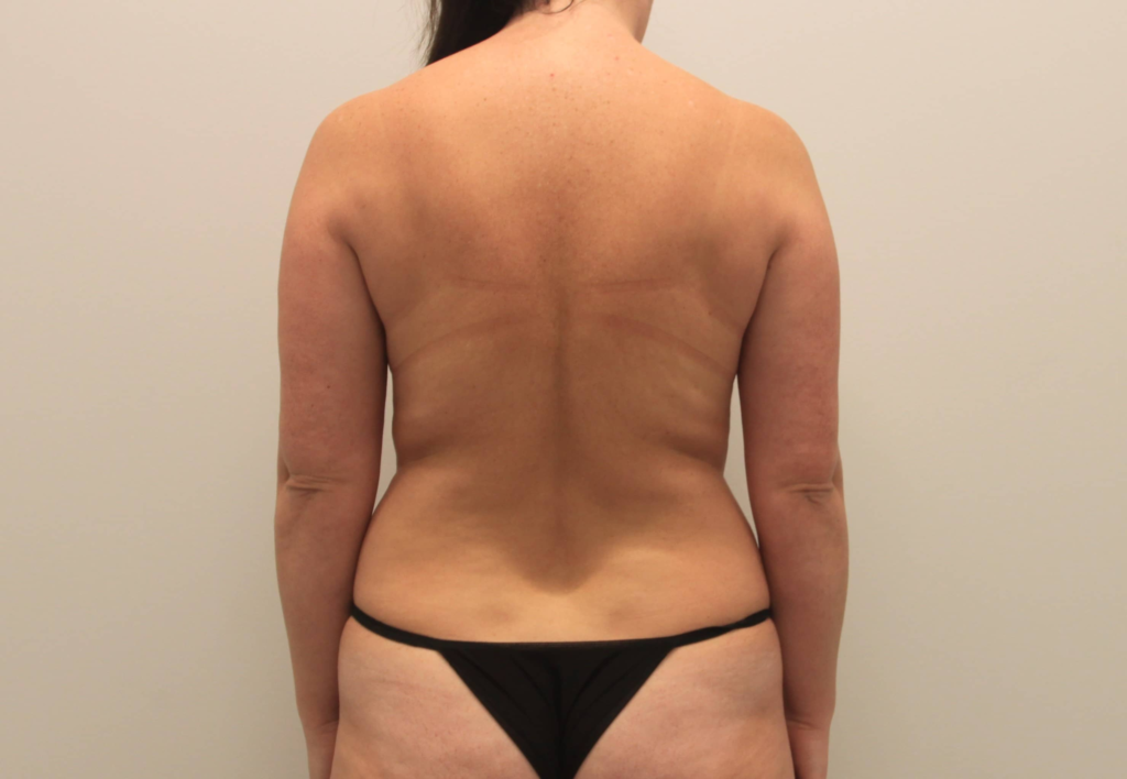 360 Lipo With Tummy Tuck Cost