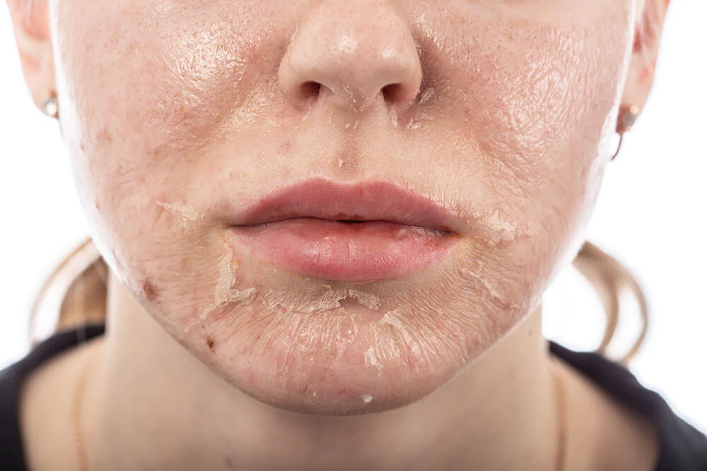 What To Know About Chemical Peel Skin