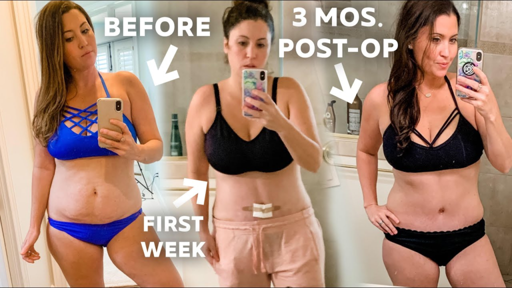Tummy Tuck Recovery Time: What to Expect and Inspiring Transformation Photos