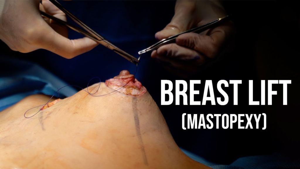 Breast Lift Procedure