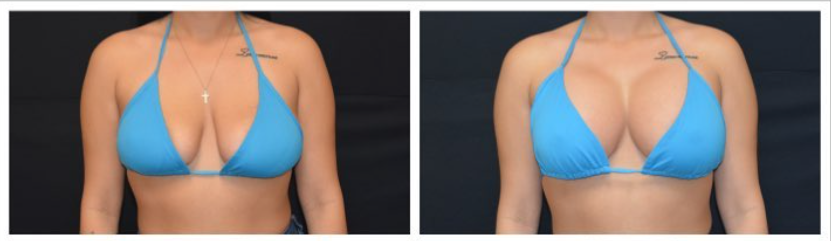 Breastlift With Augmentation