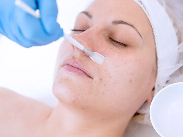 Unveiling the Power of Chemical Peels: Banishing Acne Scars