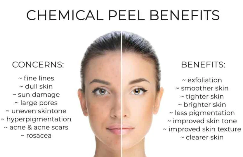 Chemical Peel Benefits Before And After Acne