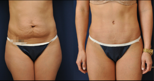 Unlocking the Secrets of a Flawless Tummy Tuck: Your Comprehensive Guide