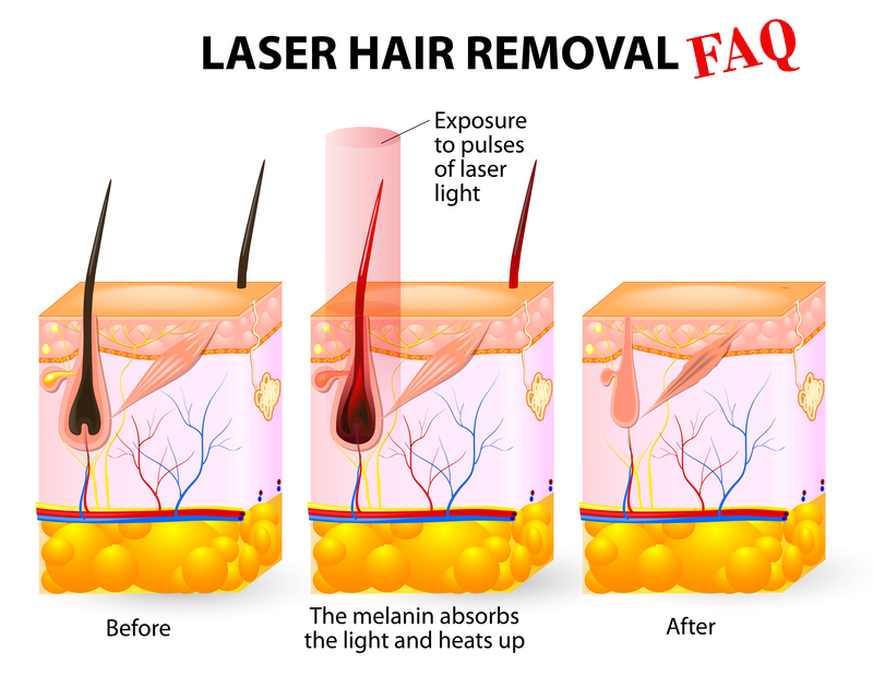 How Long Does 8 Sessions of Laser Hair Removal Last?