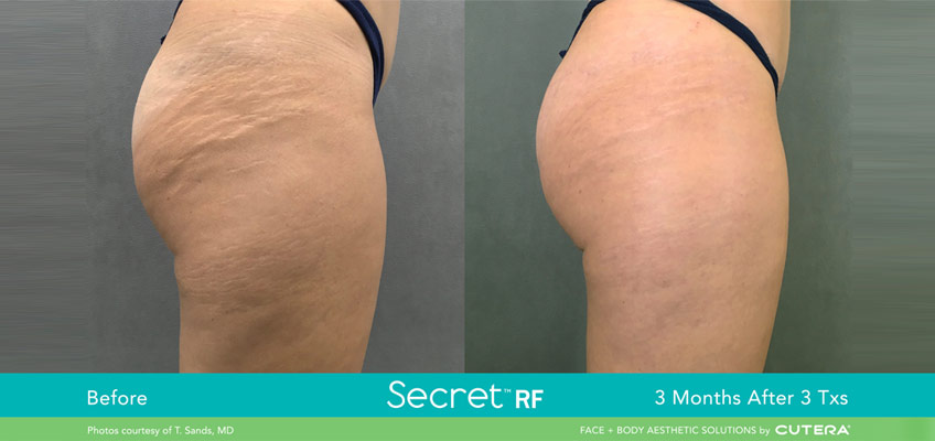 Etwo Laser For Stretch Marks