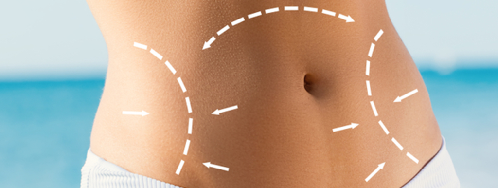 Requirements For Tummy Tuck