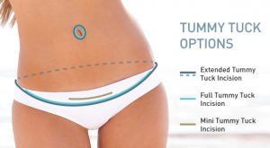 Average Cost Of Tummy Tuck In NC
